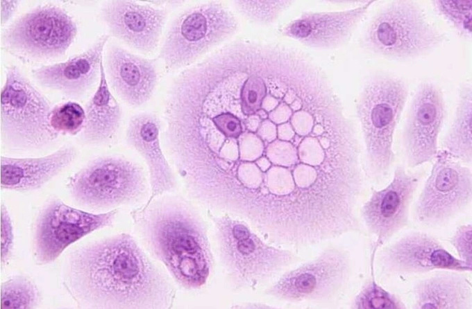 dieu-tri-ung-thu-da-bang-virus-herpes