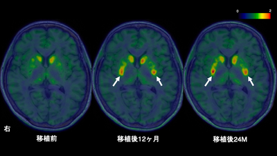 thu-nghiem-lam-sang-su-dung-te-bao-ips-trong-dieu-tri-parkinson-xac-nhan-hieu-qua-chuan-bi-nop-ho-so-phe-duyet-ung-dung-tai-nhat-ban
