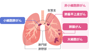 ung-thu-phoi-co-nhung-loai-nao-phan-loai-mo-hoc-va-dac-diem-tung-loai