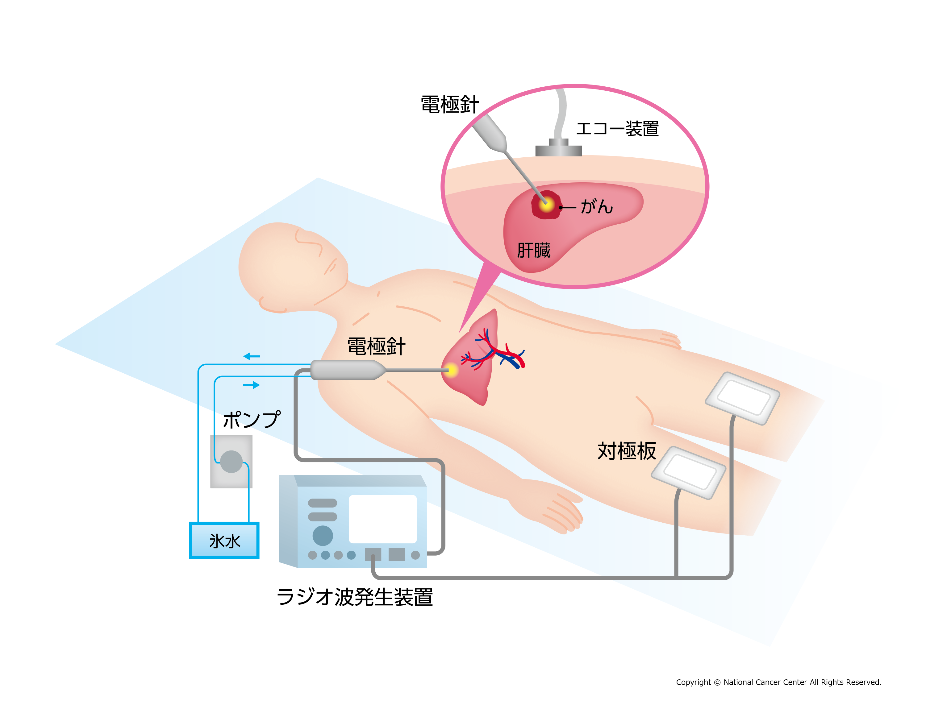 cac-phuong-phap-dieu-tri-ung-thu-gan-theo-tieu-chuan-nhat-ban-ncc-vjiic