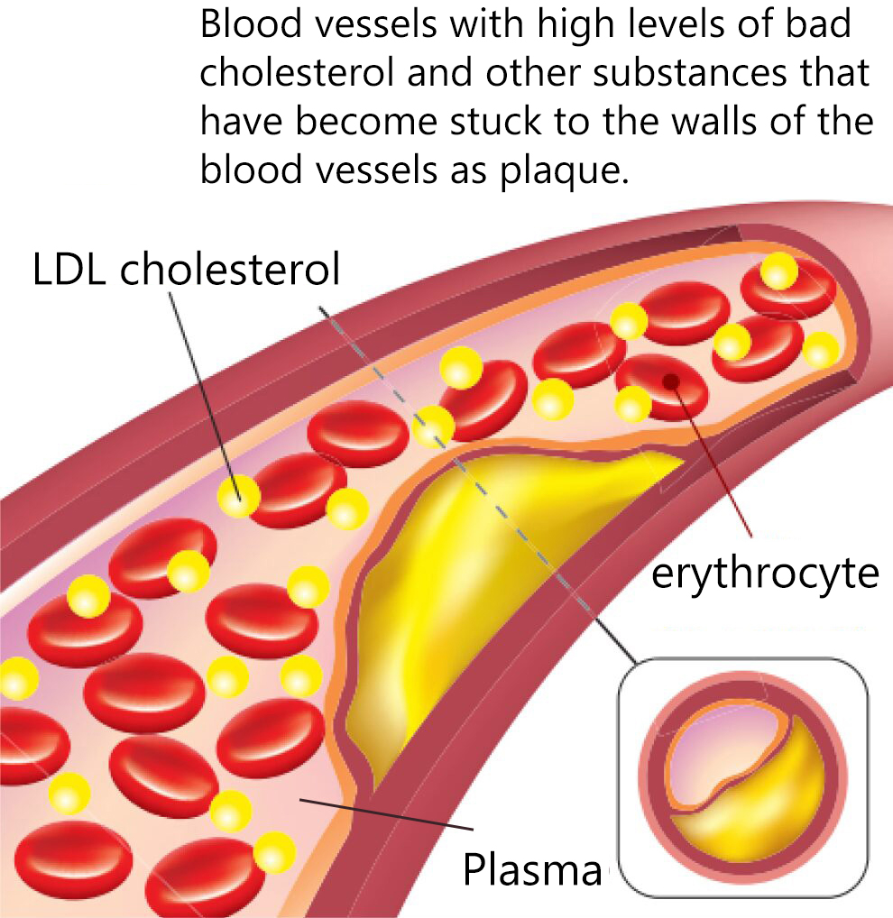 gioi-thieu-lieu-phap-thanh-loc-mau-apheresis-tai-phong-kham-tokyo-midtown