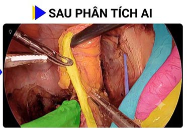 phau-thuat-xuyen-thau-khi-ai-giai-ma-me-cung-giai-phau-vung-chau-cua-co-the-nguoi